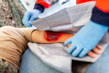 first aid bandage on burnt wound victim