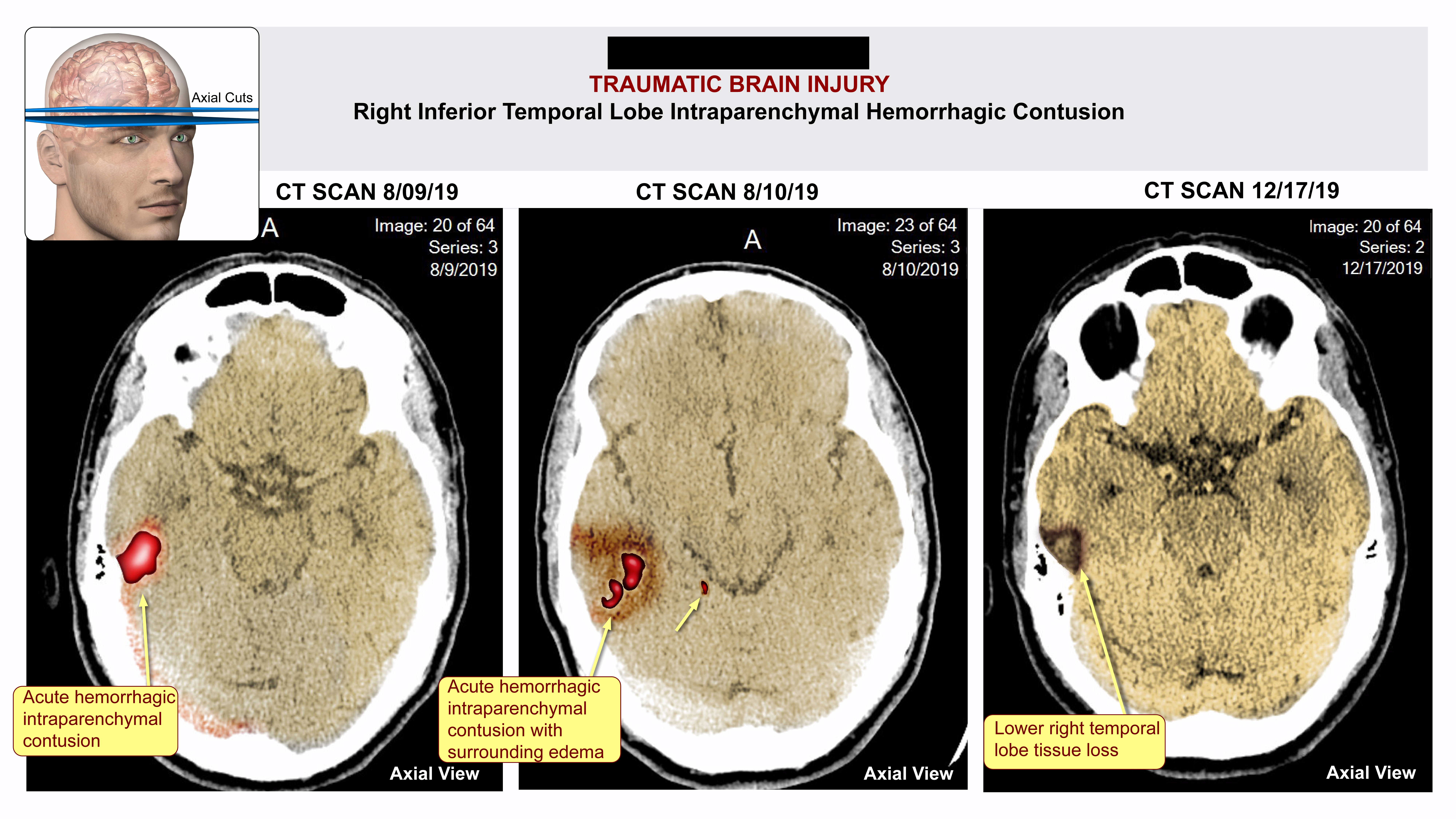 Brain Injury