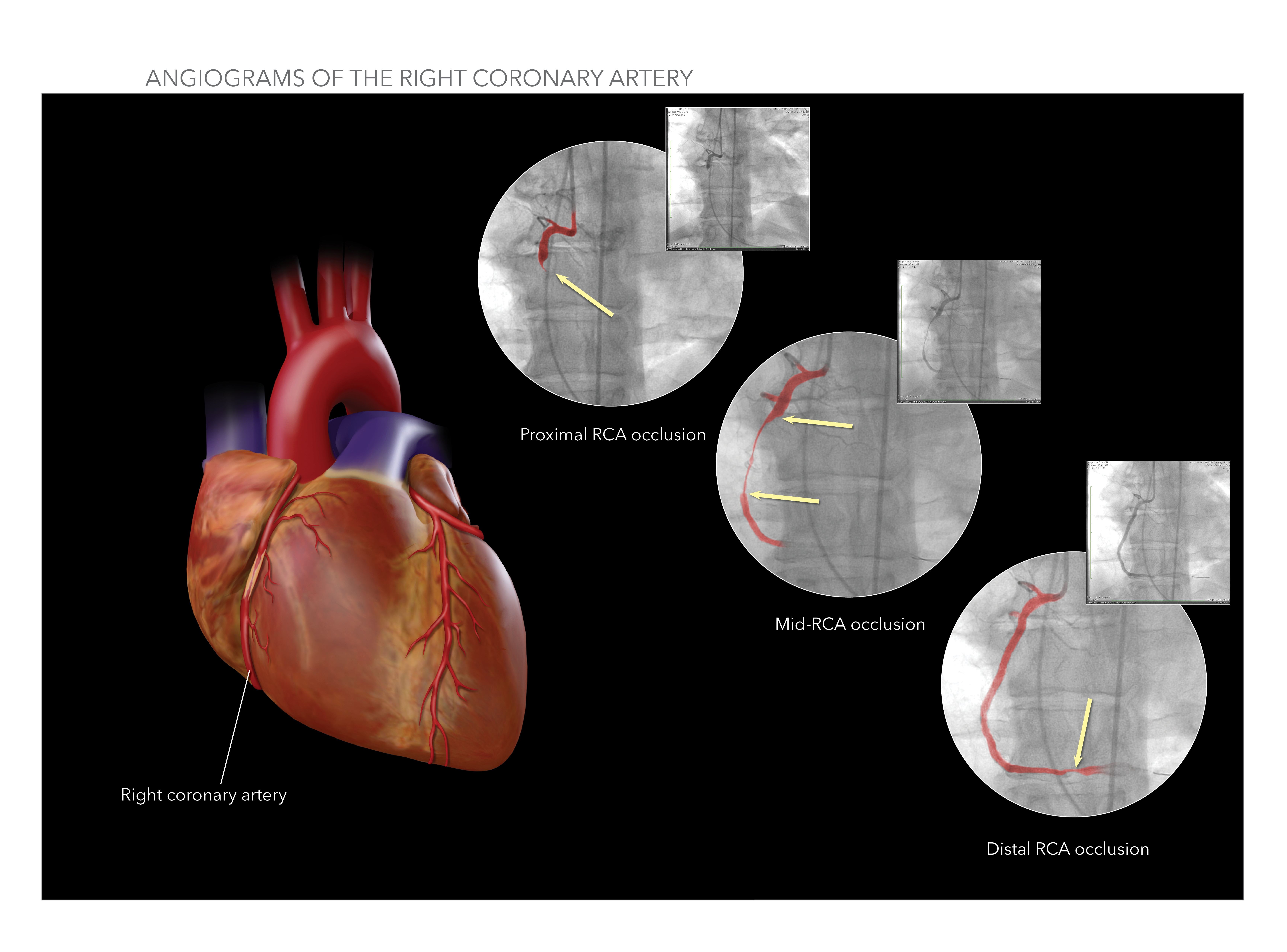 Misdiagnosing Heart Disease